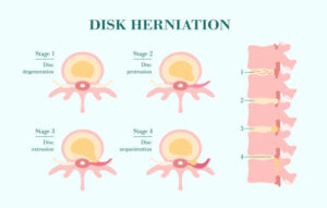 허리디스크 단계별 증상 : 추간판 탈출증 4개 단계 Herniated spinal disc - 팽윤 (Degenerative), 돌출 (Protrusion),탈출 (Extrusion), 격리 (Sequestration)