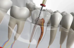 바이탈 루트 캐널 치료: 현대 치과의학에서의 핵심 접근법