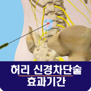 허리 신경차단술 효과기간, 경막외 신경차단술 비용